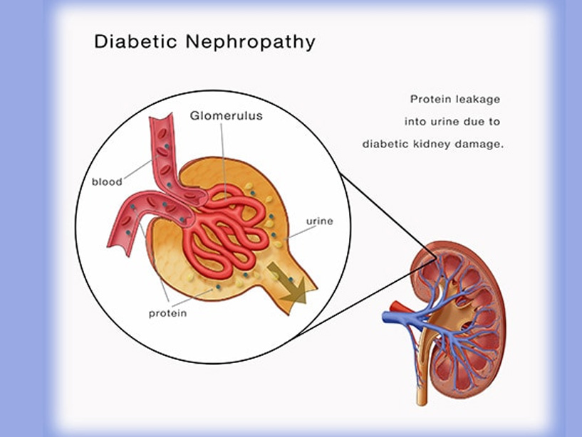Diabetes Kidney Care - Diabetic Nephropathy by Dr. Nitin Agrawal at Lotus Healthcare & Advanced Diabetes Center in Vashi, Navi Mumbai